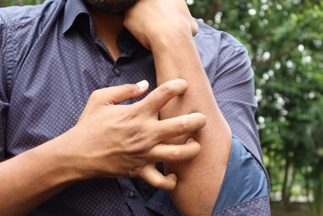 Como funciona o tratamento online para dermatite e eczema